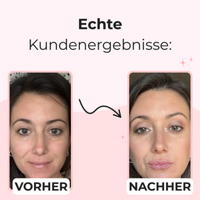 LipBoost Set - Kusslippen ohne Spritzen